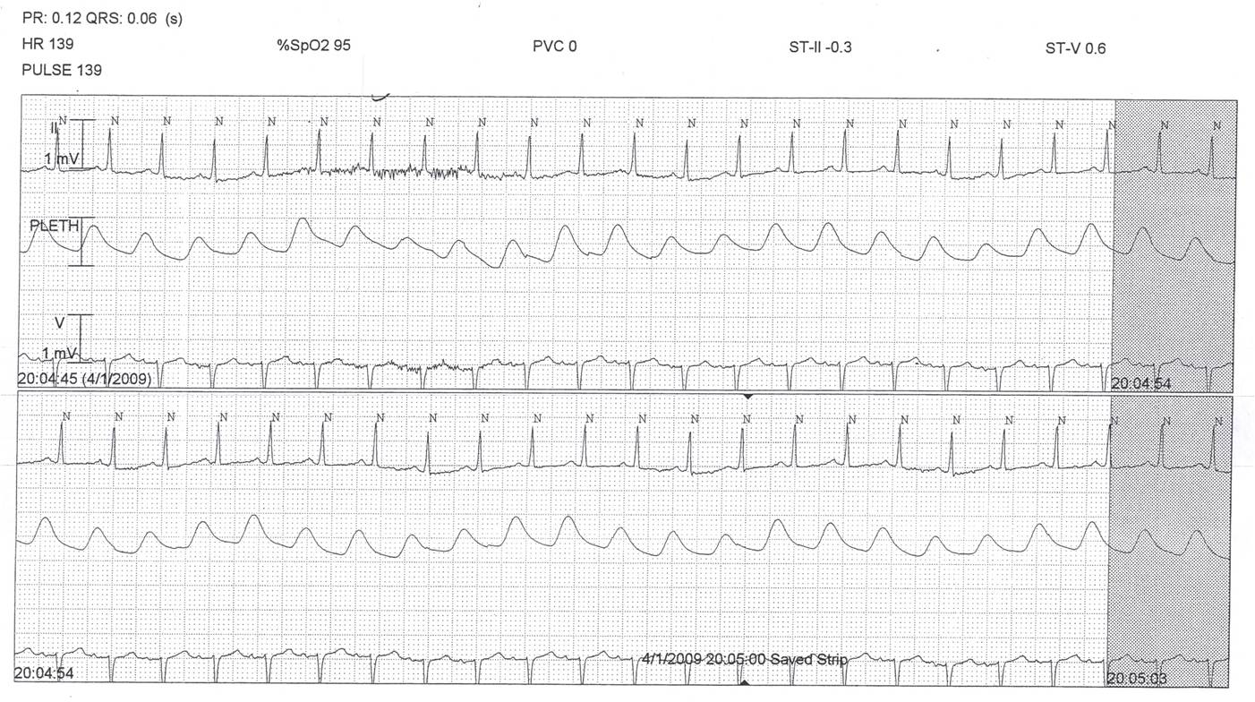 Pulsus Paradoxus Arterial Waveform